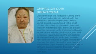 On examination she had gross swelling of the
chest wall and abdomen extending to the
ankles and wrists in the periphery. Breath
sounds could be auscultated with a small
amount of continuous pressure to the chest
wall with the stethoscope. There was a hyper-
resonant percussion note and reduced breath
sounds on the left side of the thorax, with mild
tenderness to percussion on the left posterior
thorax over the eighth, ninth, and tenth ribs.
Her vision was reduced owing to restricted eye
opening, but when her eyelids were opened
manually her pupils were equal and reactive to
light and accommodation bilaterally. Visual
acuity and eye movements were normal in
both eyes.
CREPITUS, SUB Q AIR,
SUBEMPHYSEMA
 