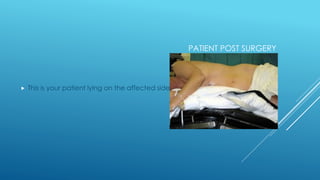 PATIENT POST SURGERY
 This is your patient lying on the affected side
 