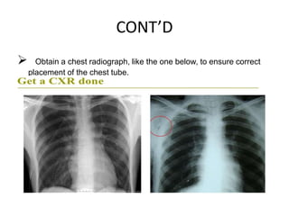 Chest tube insertion | PPTX