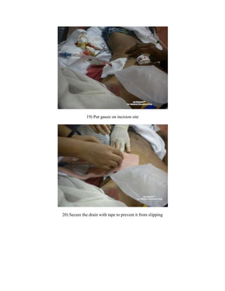 Suture materials.Location (Safety triangle)<br />4th to 6th intercostals space