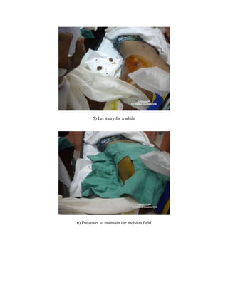 Traumatic Haemopneumothorax