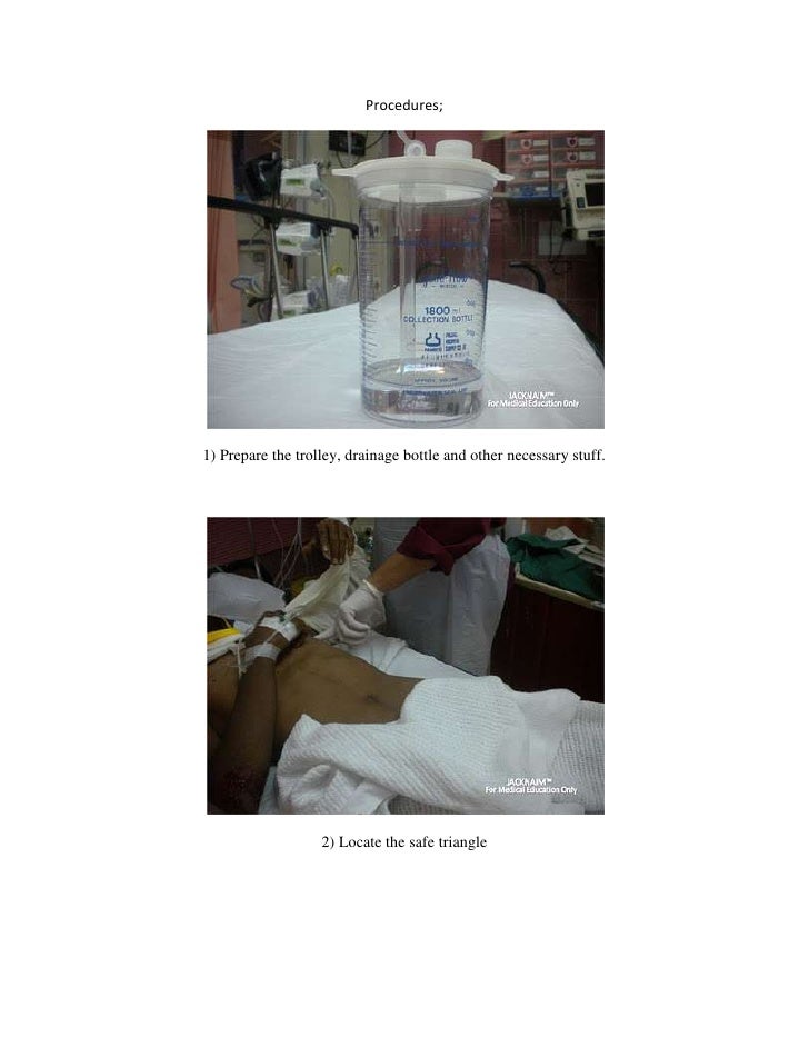 Chest Tube Insertion Made Easy