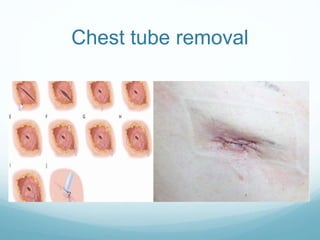 Chest tube removal
 
