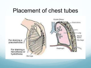 Placement of chest tubes
 