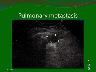 Pulmonary metastasis
11/21/2022
1
0
0
 