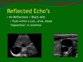 Reflected Echo’s
 No Reflections = Black dots
 Fluid within a cyst, urine, blood
‘Hypoechoic’ or echofree
 