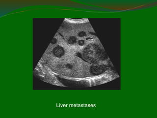 Liver metastases
 