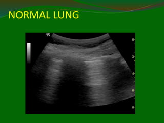 NORMAL LUNG
 