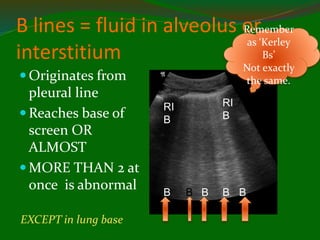 B lines = fluid in alveolus or
interstitium
 Originates from
pleural line
 Reaches base of
screen OR
ALMOST
 MORE THAN 2 at
once is abnormal
EXCEPT in lung base
Remember
as ‘Kerley
Bs’
Not exactly
the same.
RI
B
RI
B
B B B B
B
 