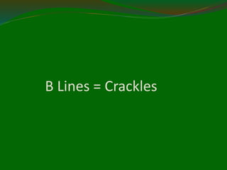 B Lines = Crackles
 
