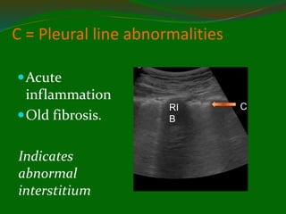C = Pleural line abnormalities
Acute
inflammation
Old fibrosis.
Indicates
abnormal
interstitium
RI
B
C
 