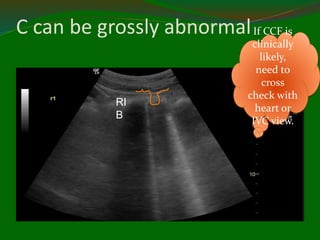 C can be grossly abnormalIf CCF is
clinically
likely,
need to
cross
check with
heart or
IVC view.
RI
B
 