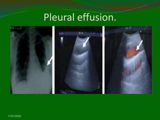 Pleural effusion.
11/21/2022
 