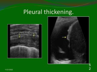 Pleural thickening.
11/21/2022
5
2
 