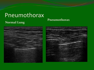 Pneumothorax
Normal Lung
Pneumothorax
 