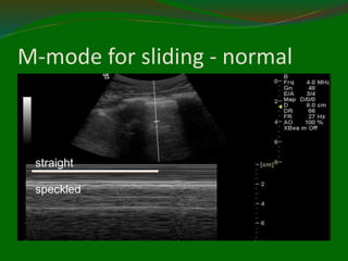 M-mode for sliding - normal
straight
speckled
 
