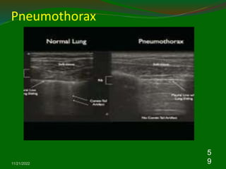 Pneumothorax
11/21/2022
5
9
 