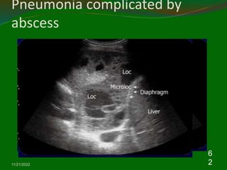 Pneumonia complicated by
abscess
11/21/2022
6
2
 