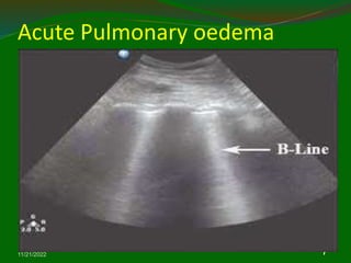 Acute Pulmonary oedema
11/21/2022
6
7
 