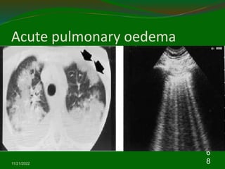 Acute pulmonary oedema
11/21/2022
6
8
 
