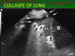 COLLASPE OF LUNG
11/21/2022
7
4
 