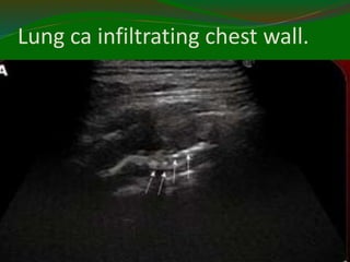 Lung ca infiltrating chest wall.
11/21/2022
7
6
 