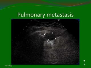 Pulmonary metastasis
11/21/2022
7
7
 
