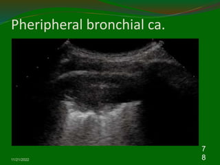 Pheripheral bronchial ca.
11/21/2022
7
8
 