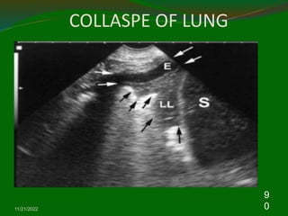 COLLASPE OF LUNG
11/21/2022
9
0
 