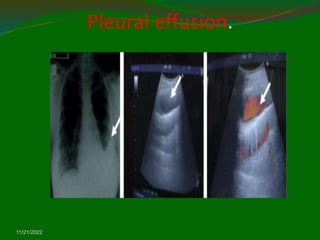 Pleural effusion.
11/21/2022
 