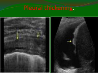 Pleural thickening.
11/21/2022
9
4
 