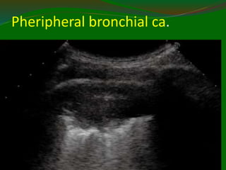Pheripheral bronchial ca.
11/21/2022
9
7
 