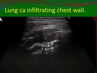 Lung ca infiltrating chest wall.
11/21/2022
9
8
 