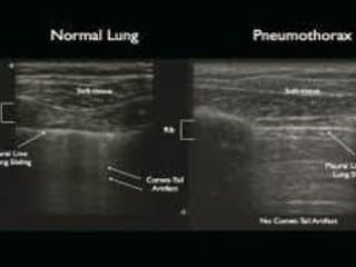 Chest ultrasound | PPT