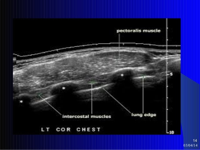 Chest ultrasound
