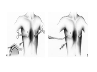 Chest wall deformities | PDF