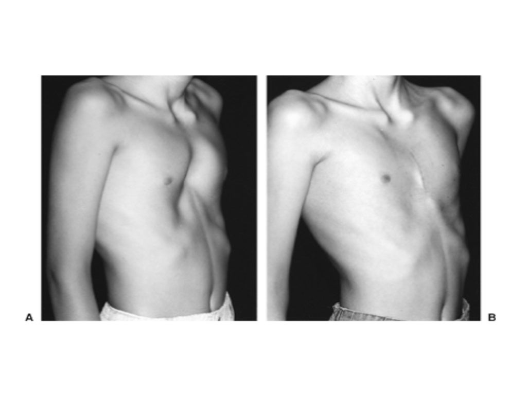 Chest wall deformities