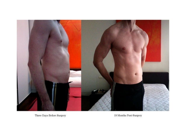 Chest wall deformities
