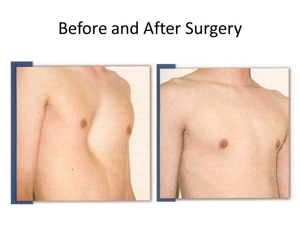 Chest Wall Deformity