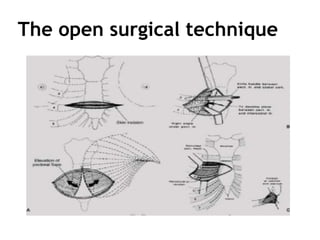 The open surgical technique
 