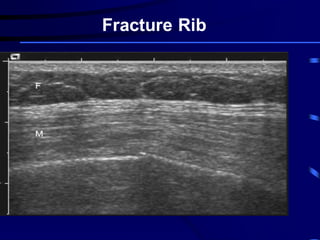 Chest Wall Ultrasound | PDF
