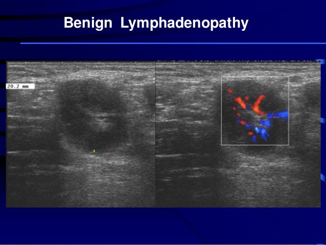 Chest Wall Ultrasound