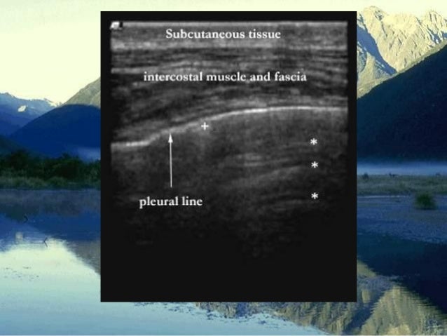 Chest Wall Ultrasound