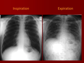 Inspiration

Expiration

 