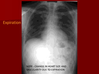Expiration

NOTE - CHANGE IN HEART SIZE AND
VASCULARITY DUE TO EXPIRATION

 