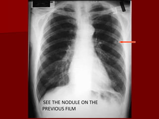 SEE THE NODULE ON THE
PREVIOUS FILM

 
