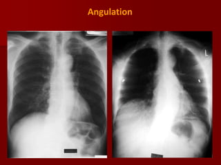 Angulation

 