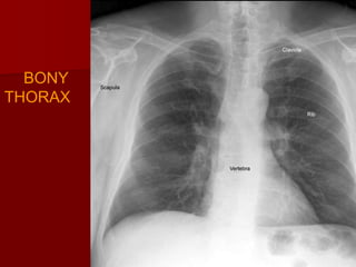 BONY
THORAX

 