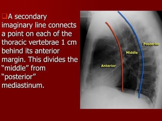 A secondary
imaginary line connects
a point on each of the
thoracic vertebrae 1 cm
behind its anterior
margin. This divides the
“middle” from
“posterior”
mediastinum.

 