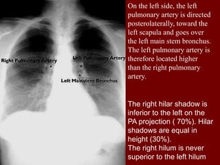 On the left side, the left
pulmonary artery is directed
posterolaterally, toward the
left scapula and goes over
the left main stem bronchus.
The left pulmonary artery is
therefore located higher
than the right pulmonary
artery.

The right hilar shadow is
inferior to the left on the
PA projection ( 70%). Hilar
shadows are equal in
height (30%).
The right hilum is never
superior to the left hilum

 